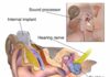 Perbedaan Implan Koklea vs Alat Bantu Dengar